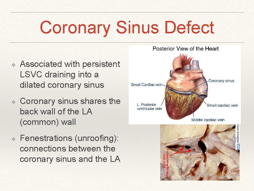 Coronary Sinus Defect ❖ ❖ ❖ Associated with persistent LSVC draining into a dilated Coronary Sinus Defect ❖ ❖ ❖ Associated with persistent LSVC draining into a dilated
