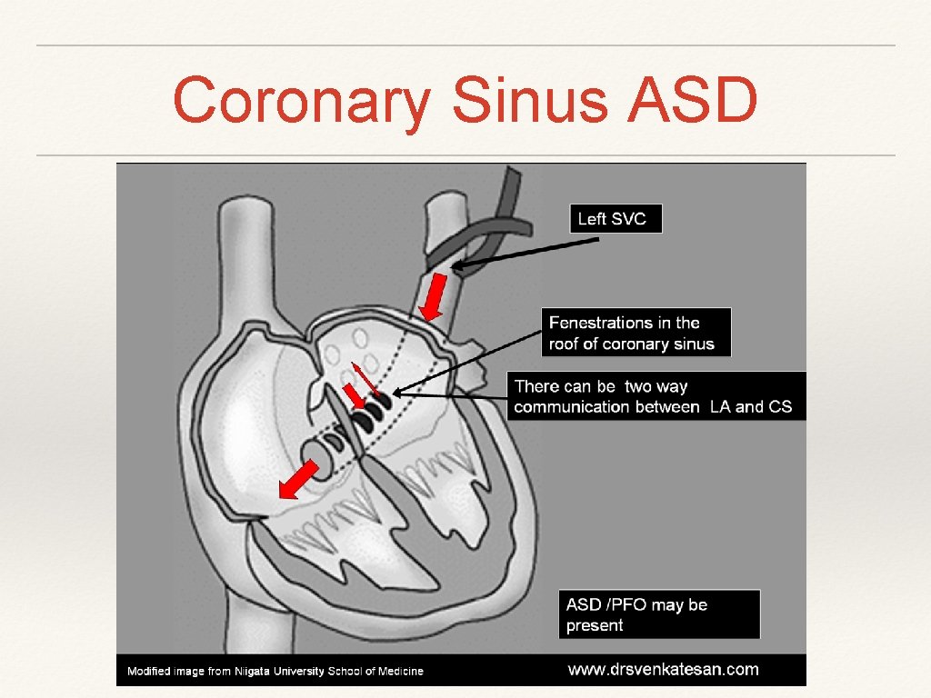 Coronary Sinus ASD Coronary Sinus ASD