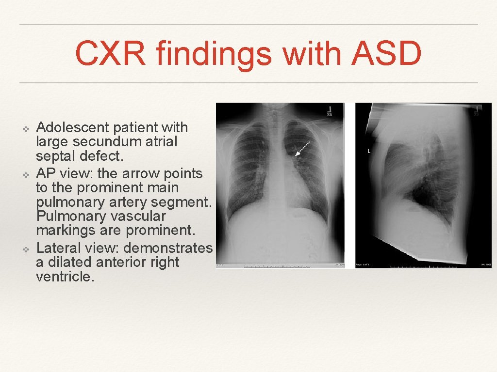 CXR findings with ASD ❖ ❖ ❖ Adolescent patient with large secundum atrial septal CXR findings with ASD ❖ ❖ ❖ Adolescent patient with large secundum atrial septal
