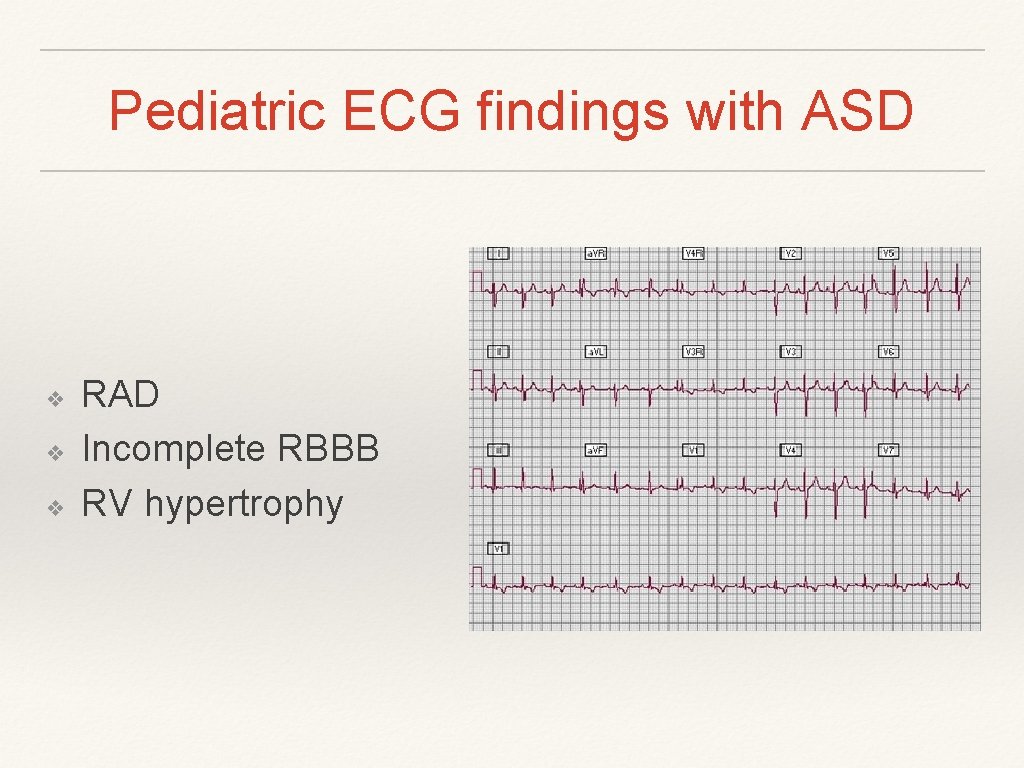 Pediatric ECG findings with ASD ❖ ❖ ❖ RAD Incomplete RBBB RV hypertrophy Pediatric ECG findings with ASD ❖ ❖ ❖ RAD Incomplete RBBB RV hypertrophy