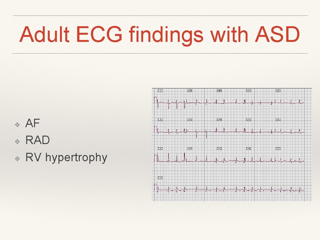 Adult ECG findings with ASD ❖ ❖ ❖ AF RAD RV hypertrophy Adult ECG findings with ASD ❖ ❖ ❖ AF RAD RV hypertrophy
