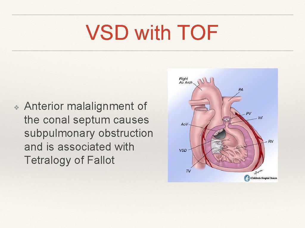 VSD with TOF ❖ Anterior malalignment of the conal septum causes subpulmonary obstruction and VSD with TOF ❖ Anterior malalignment of the conal septum causes subpulmonary obstruction and