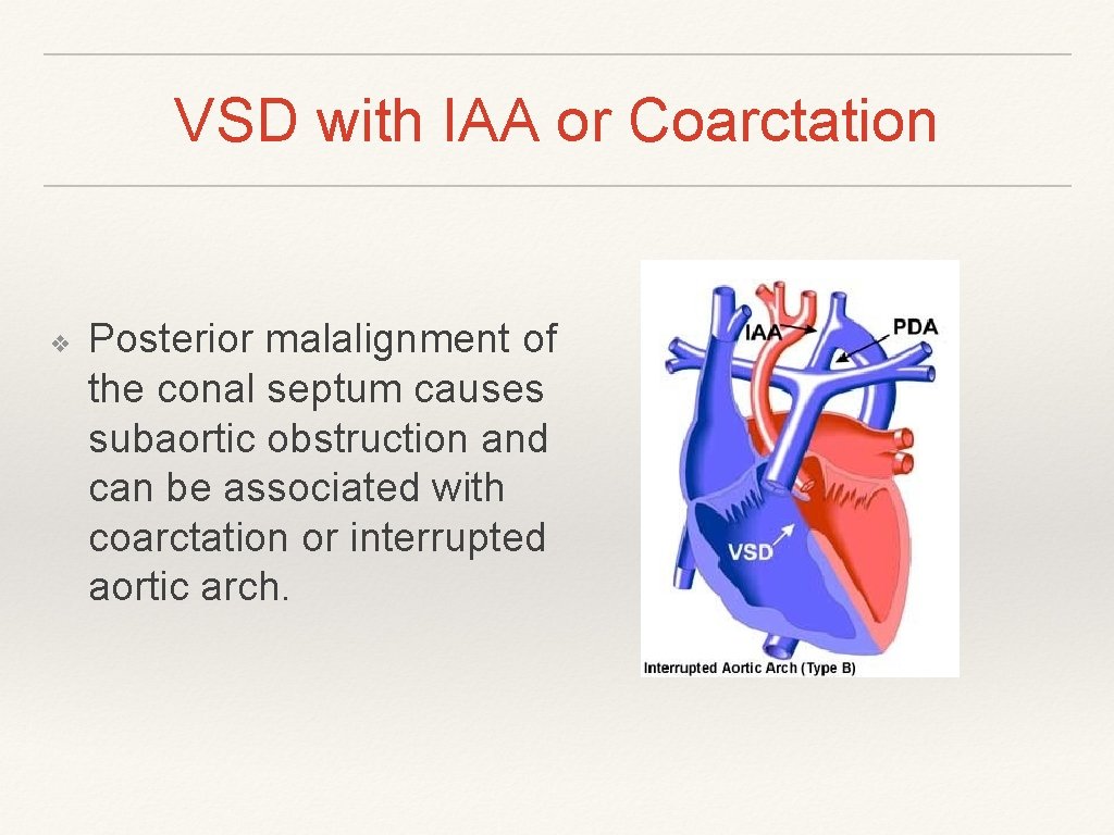 VSD with IAA or Coarctation ❖ Posterior malalignment of the conal septum causes subaortic VSD with IAA or Coarctation ❖ Posterior malalignment of the conal septum causes subaortic