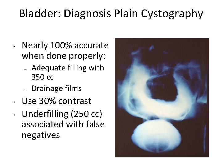 Bladder: Diagnosis Plain Cystography • Nearly 100% accurate when done properly: – – •