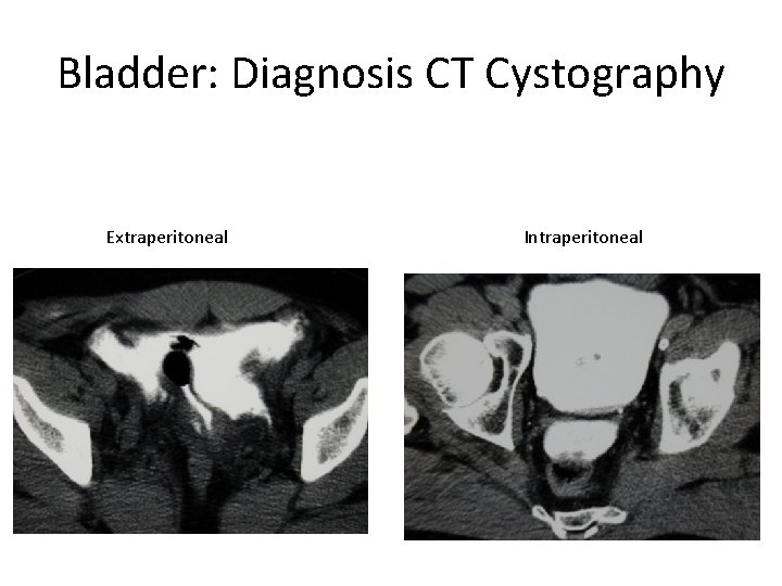 Bladder: Diagnosis CT Cystography Extraperitoneal Intraperitoneal 