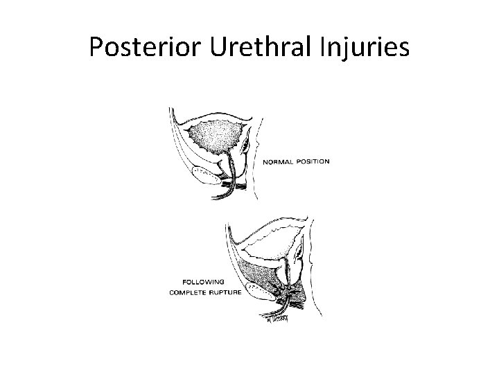 Posterior Urethral Injuries 
