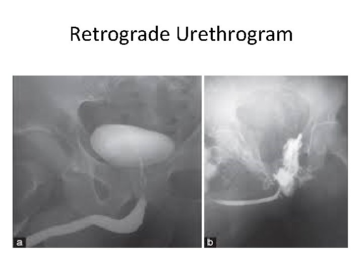 Retrograde Urethrogram 