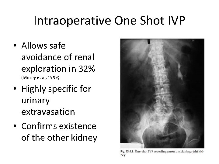 Intraoperative One Shot IVP • Allows safe avoidance of renal exploration in 32% (Morey