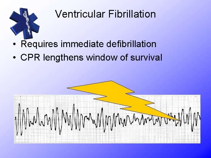 Ventricular Fibrillation • Requires immediate defibrillation • CPR lengthens window of survival 