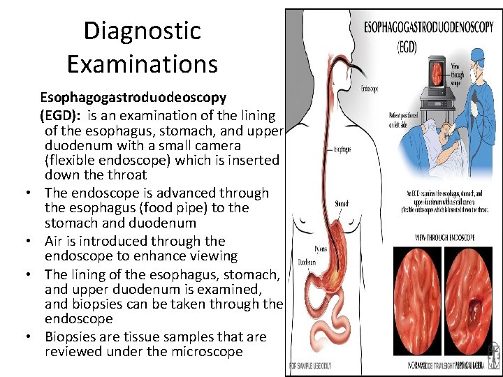 Diagnostic Examinations • • Esophagogastroduodeoscopy (EGD): is an examination of the lining of the