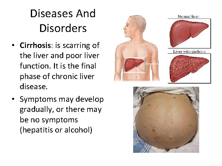 Diseases And Disorders • Cirrhosis: is scarring of the liver and poor liver function.