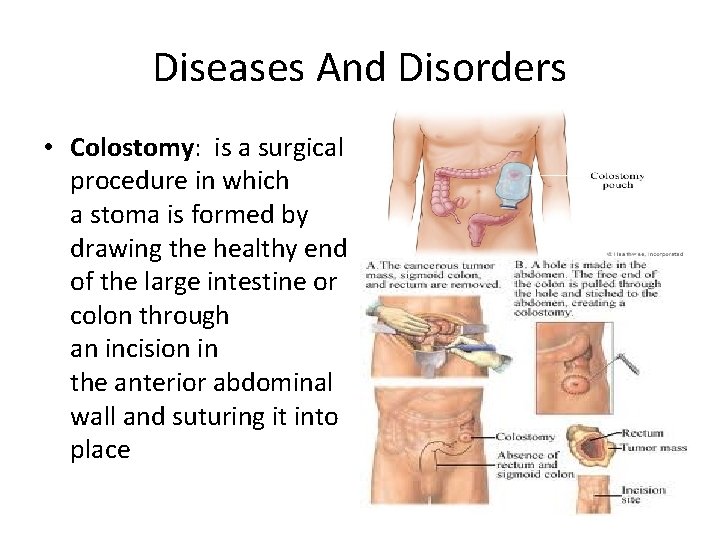 Diseases And Disorders • Colostomy: is a surgical procedure in which a stoma is