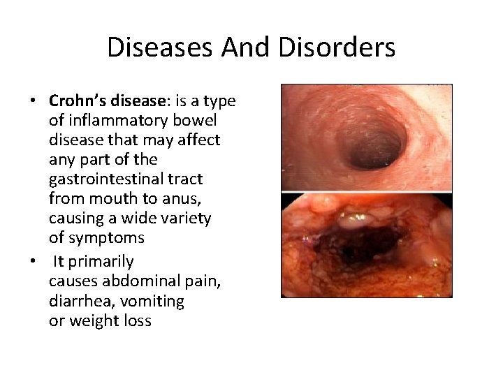 Diseases And Disorders • Crohn’s disease: is a type of inflammatory bowel disease that