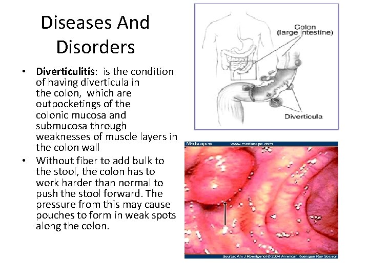 Diseases And Disorders • Diverticulitis: is the condition of having diverticula in the colon,