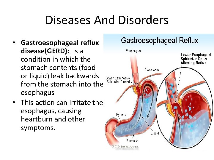 Diseases And Disorders • Gastroesophageal reflux disease(GERD): is a condition in which the stomach