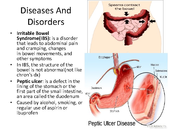 Diseases And Disorders • Irritable Bowel Syndrome(IBS): is a disorder that leads to abdominal