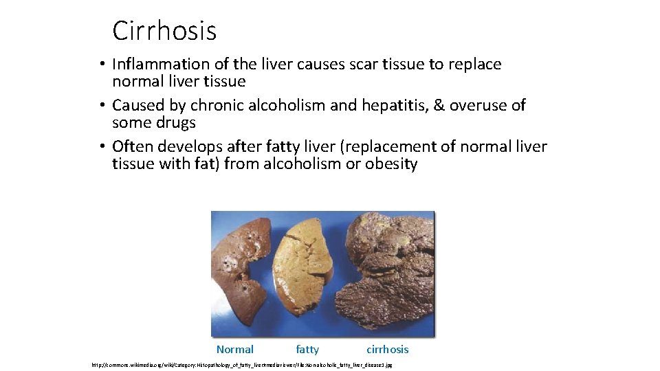 Cirrhosis • Inflammation of the liver causes scar tissue to replace normal liver tissue