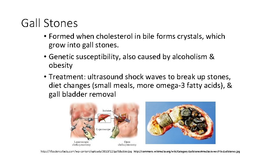 Gall Stones • Formed when cholesterol in bile forms crystals, which grow into gall