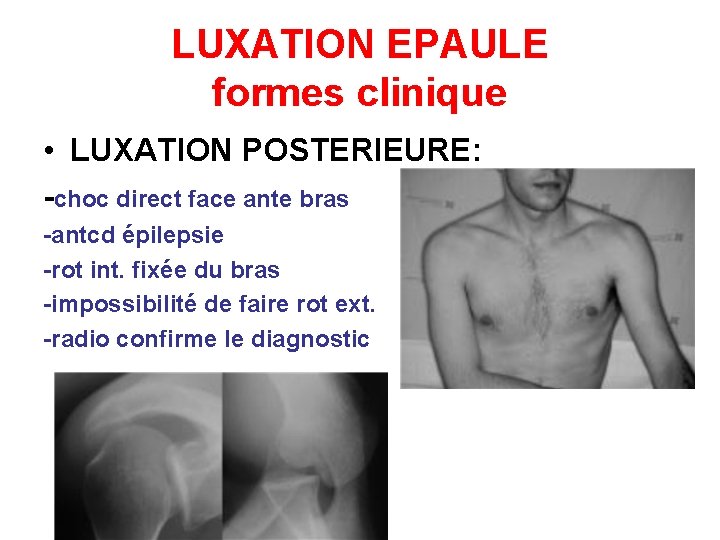 LUXATION EPAULE formes clinique • LUXATION POSTERIEURE: -choc direct face ante bras -antcd épilepsie