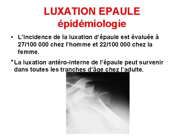 LUXATION EPAULE épidémiologie • L’incidence de la luxation d’épaule est évaluée à 27/100 000