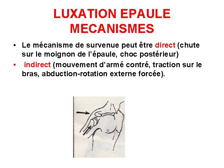 LUXATION EPAULE MECANISMES • Le mécanisme de survenue peut être direct (chute sur le