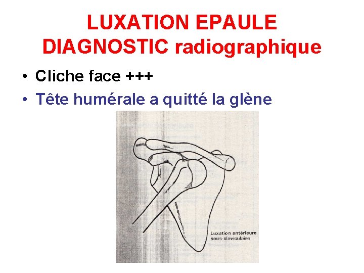 LUXATION EPAULE DIAGNOSTIC radiographique • Cliche face +++ • Tête humérale a quitté la