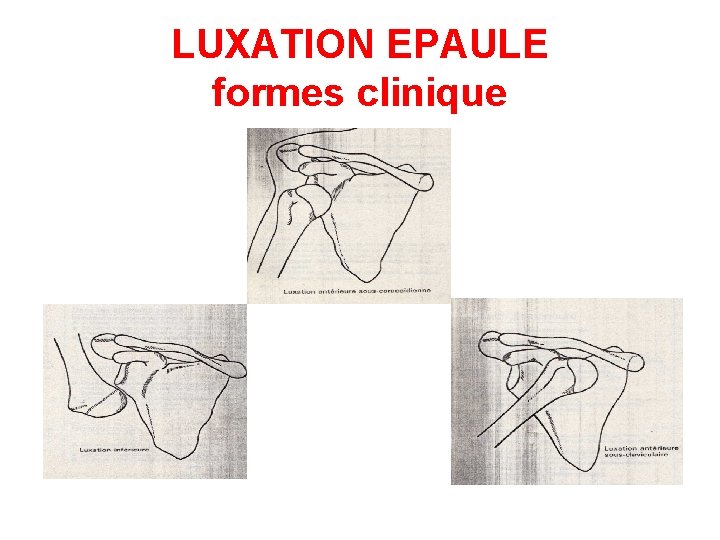 LUXATION EPAULE formes clinique 