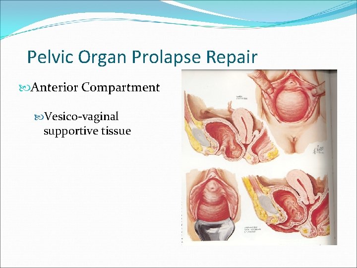 Pelvic Organ Prolapse Repair Anterior Compartment Vesico-vaginal supportive tissue Pelvic Organ Prolapse Repair Anterior Compartment Vesico-vaginal supportive tissue