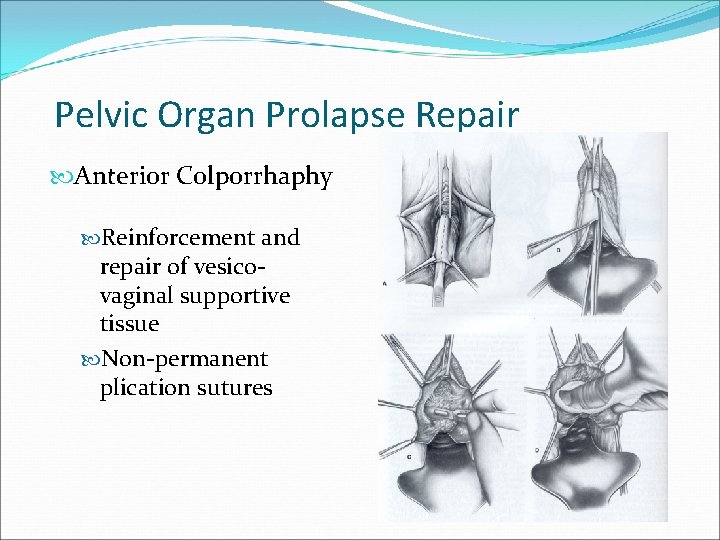 Pelvic Organ Prolapse Repair Anterior Colporrhaphy Reinforcement and repair of vesicovaginal supportive tissue Non-permanent Pelvic Organ Prolapse Repair Anterior Colporrhaphy Reinforcement and repair of vesicovaginal supportive tissue Non-permanent
