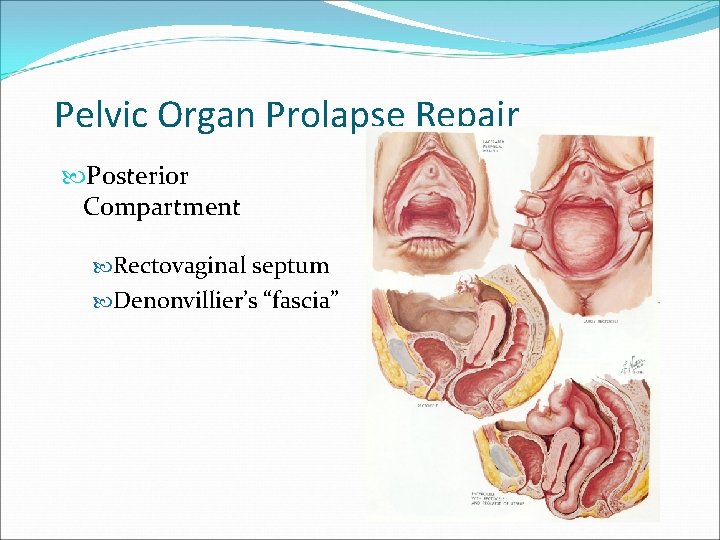 Pelvic Organ Prolapse Repair Posterior Compartment Rectovaginal septum Denonvillier’s “fascia” Pelvic Organ Prolapse Repair Posterior Compartment Rectovaginal septum Denonvillier’s “fascia”