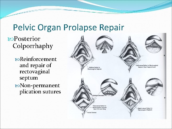 Pelvic Organ Prolapse Repair Posterior Colporrhaphy Reinforcement and repair of rectovaginal septum Non-permanent plication Pelvic Organ Prolapse Repair Posterior Colporrhaphy Reinforcement and repair of rectovaginal septum Non-permanent plication