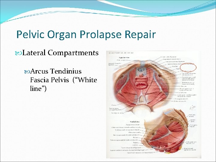 Pelvic Organ Prolapse Repair Lateral Compartments Arcus Tendinius Fascia Pelvis (“White line”) Pelvic Organ Prolapse Repair Lateral Compartments Arcus Tendinius Fascia Pelvis (“White line”)