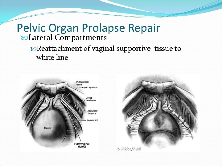 Pelvic Organ Prolapse Repair Lateral Compartments Reattachment of vaginal supportive tissue to white line Pelvic Organ Prolapse Repair Lateral Compartments Reattachment of vaginal supportive tissue to white line