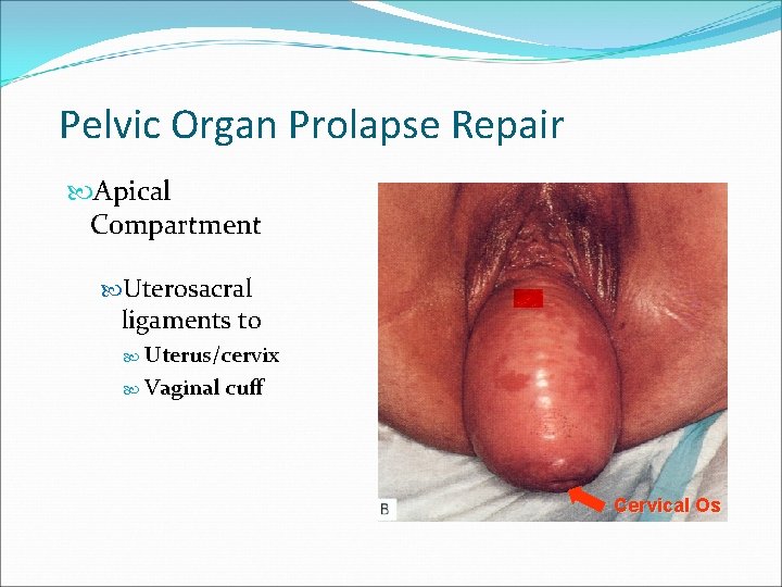 Pelvic Organ Prolapse Repair Apical Compartment Uterosacral ligaments to Uterus/cervix Vaginal cuff Cervical Os Pelvic Organ Prolapse Repair Apical Compartment Uterosacral ligaments to Uterus/cervix Vaginal cuff Cervical Os