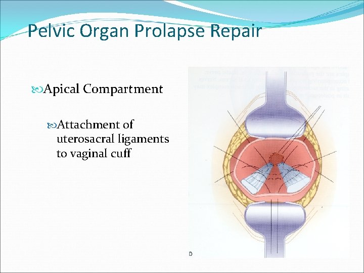 Pelvic Organ Prolapse Repair Apical Compartment Attachment of uterosacral ligaments to vaginal cuff Pelvic Organ Prolapse Repair Apical Compartment Attachment of uterosacral ligaments to vaginal cuff
