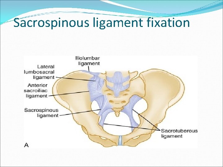 Sacrospinous ligament fixation Sacrospinous ligament fixation