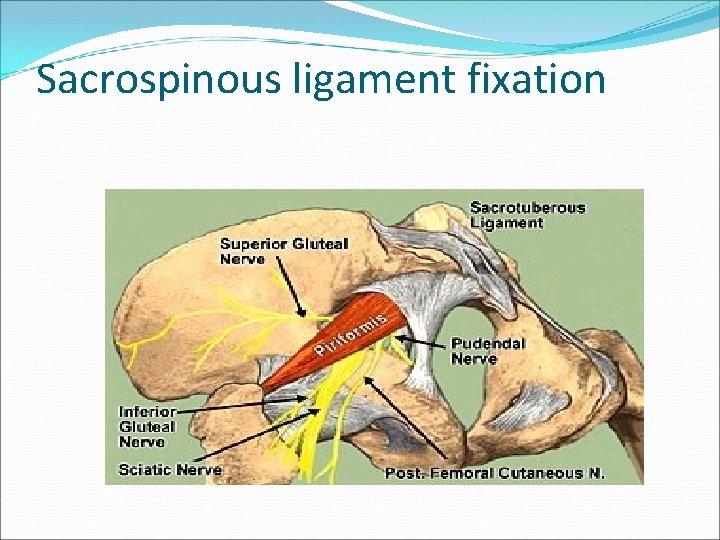Sacrospinous ligament fixation Sacrospinous ligament fixation