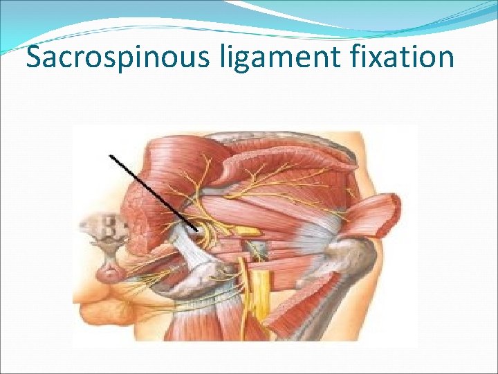 Sacrospinous ligament fixation Sacrospinous ligament fixation