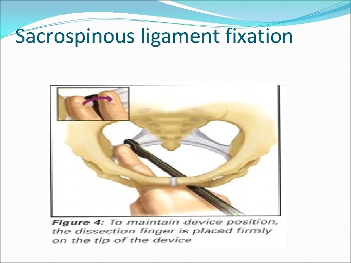 Sacrospinous ligament fixation Sacrospinous ligament fixation