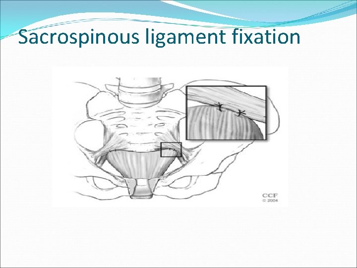 Sacrospinous ligament fixation Sacrospinous ligament fixation
