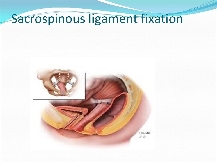 Sacrospinous ligament fixation Sacrospinous ligament fixation