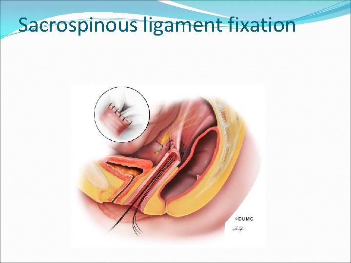 Sacrospinous ligament fixation Sacrospinous ligament fixation