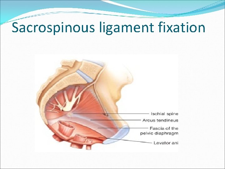 Sacrospinous ligament fixation Sacrospinous ligament fixation