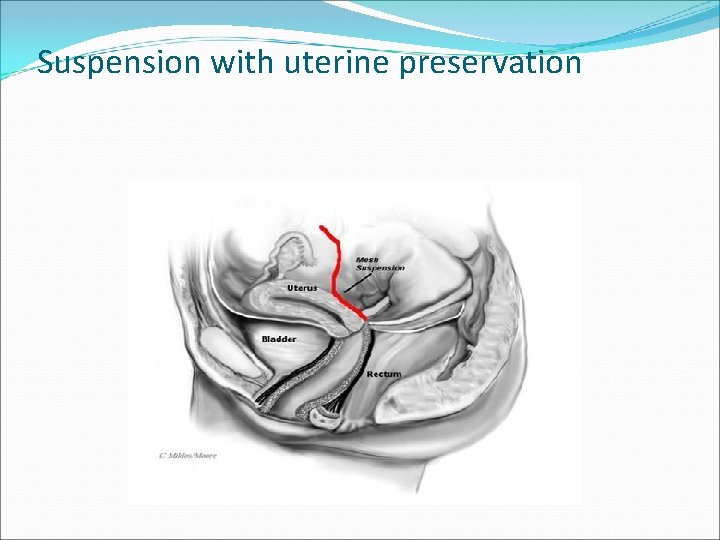 Suspension with uterine preservation Suspension with uterine preservation