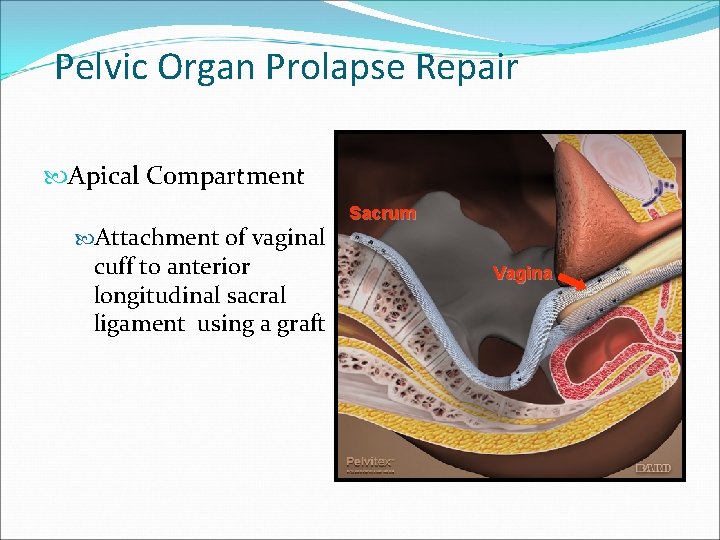 Pelvic Organ Prolapse Repair Apical Compartment Attachment of vaginal cuff to anterior longitudinal sacral Pelvic Organ Prolapse Repair Apical Compartment Attachment of vaginal cuff to anterior longitudinal sacral