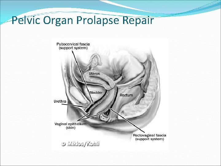 Pelvic Organ Prolapse Repair Pelvic Organ Prolapse Repair