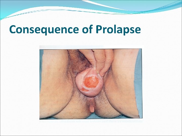 Consequence of Prolapse Consequence of Prolapse