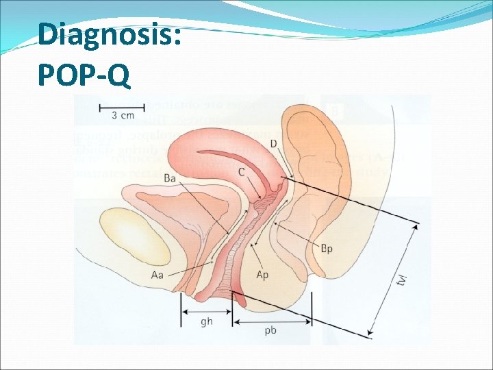 Diagnosis: POP-Q Diagnosis: POP-Q