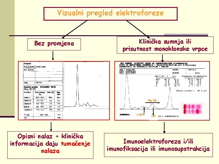 Vizualni pregled elektroforeze Bez promjena Klinička sumnja ili prisutnost monoklonske vrpce Hp-Hb CRP Opisni