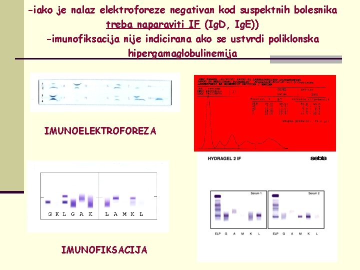 -iako je nalaz elektroforeze negativan kod suspektnih bolesnika treba naparaviti IF (Ig. D, Ig.